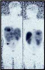  Somatostatin receptor scintigraphy (SRS)