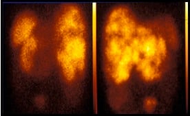  Somatostatin receptor scintigraphy (SRS)