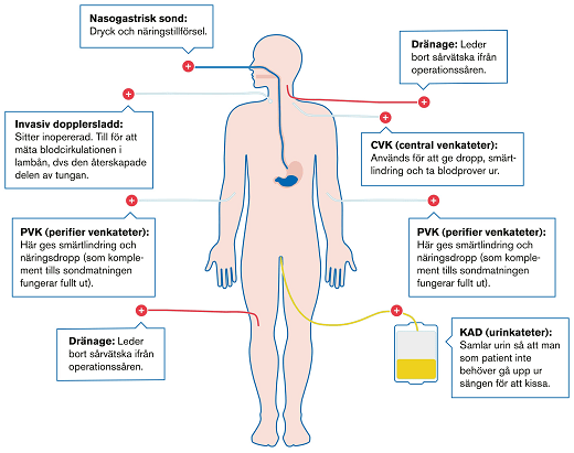 Diagram över slangar kopplade till kroppen efter operation